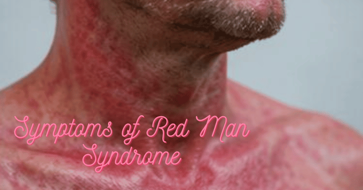 Person showing itching and skin redness from a drug reaction